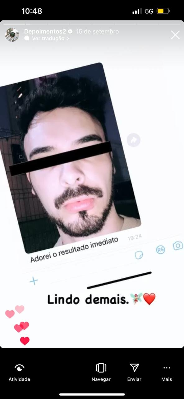 depoimento preenchimento labial2