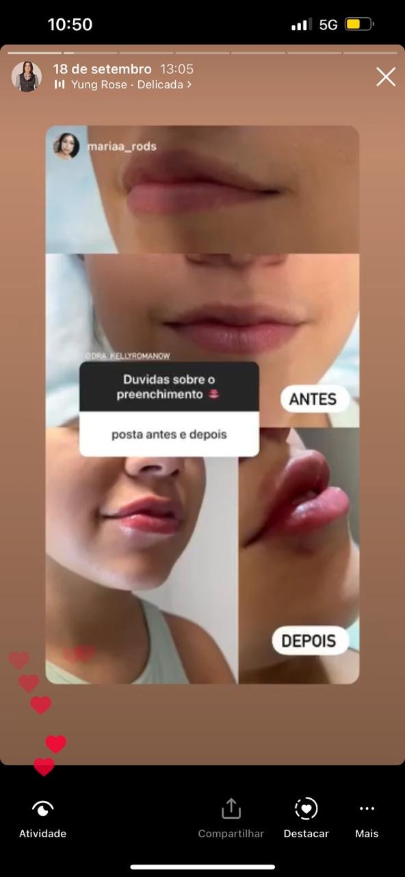 depoimento preenchimento labial3
