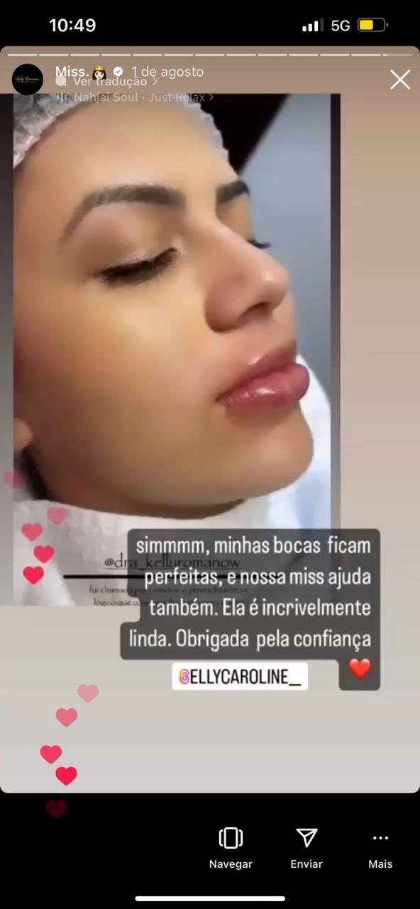 depoimento preenchimento labial4